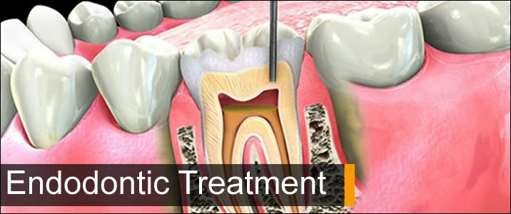 Root Canal Treatment in Jalandhar