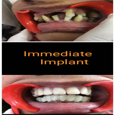 Best Dental Implant Center Jalandhar